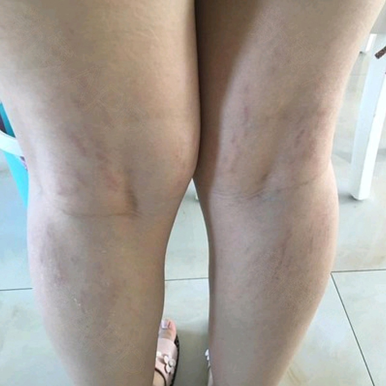 我的妊娠纹长到腿上了,而且颜色是紫色的,就很显眼难看