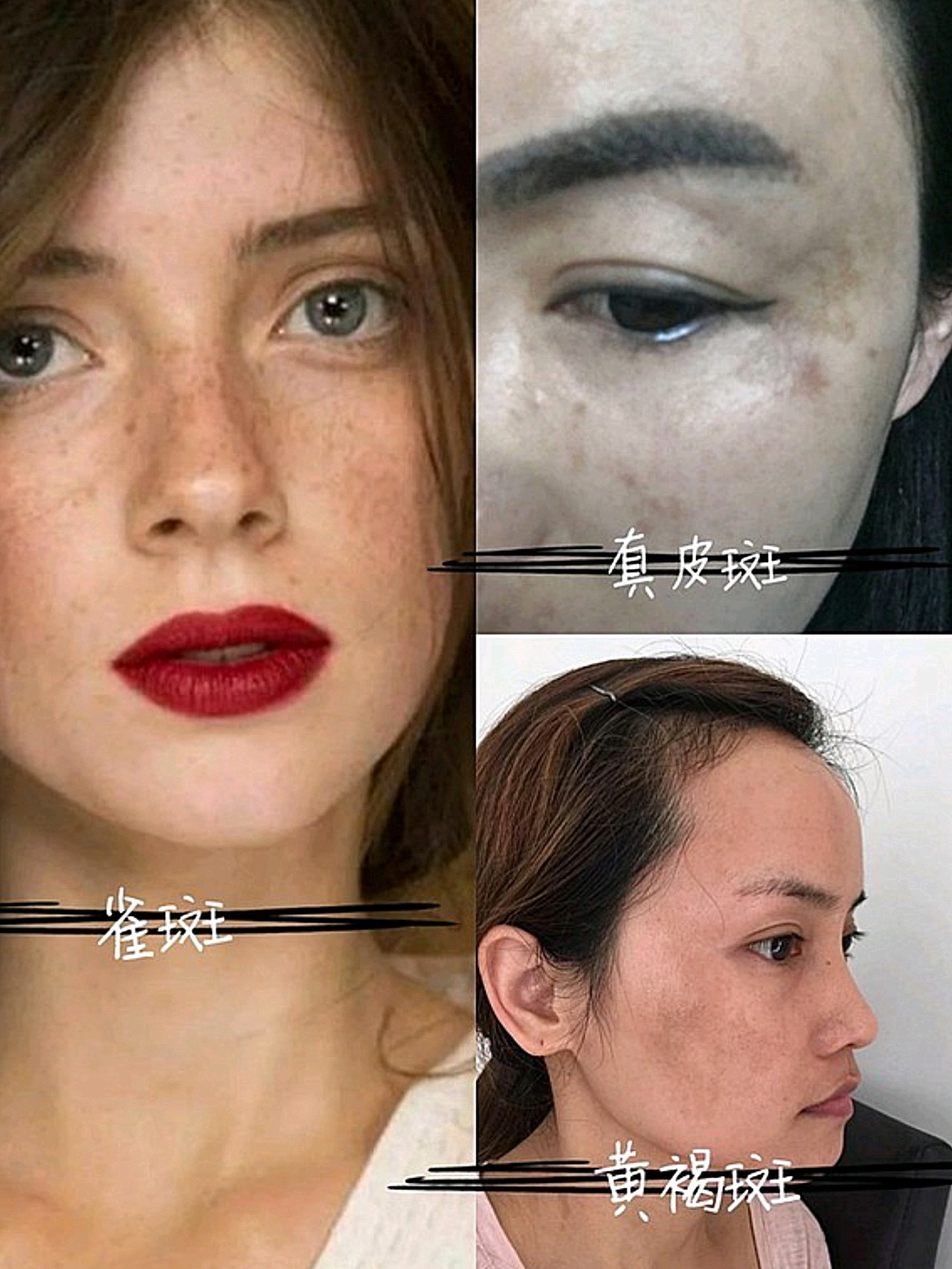 1,皮秒激光可以去多种色斑 皮秒激光对于表皮的色斑和真皮的色斑都