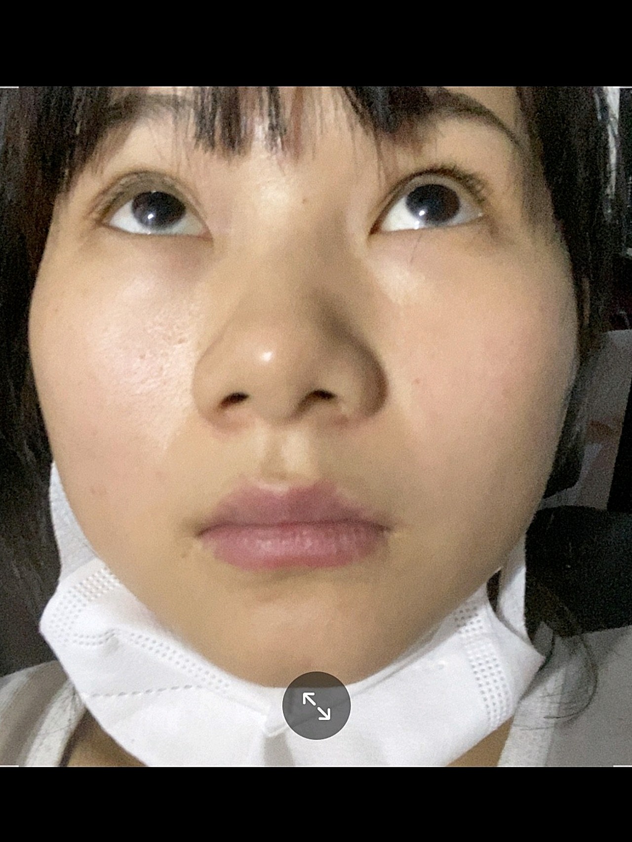 至今为止我都觉得当初选择鼻翼内切是一件很明智的选择_圈子-新氧美容