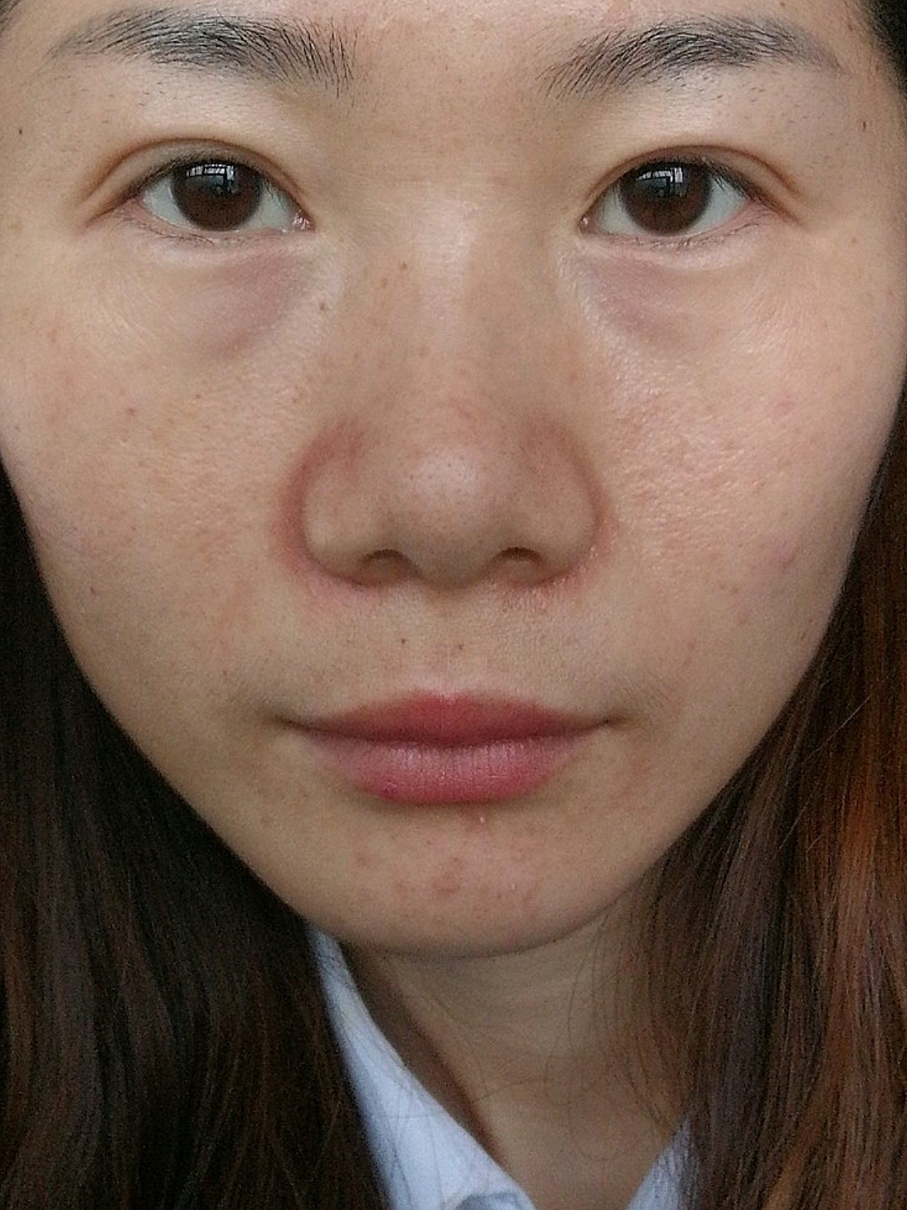23周岁,脸部脂肪少,显得特别老,眼部比较容易长斑