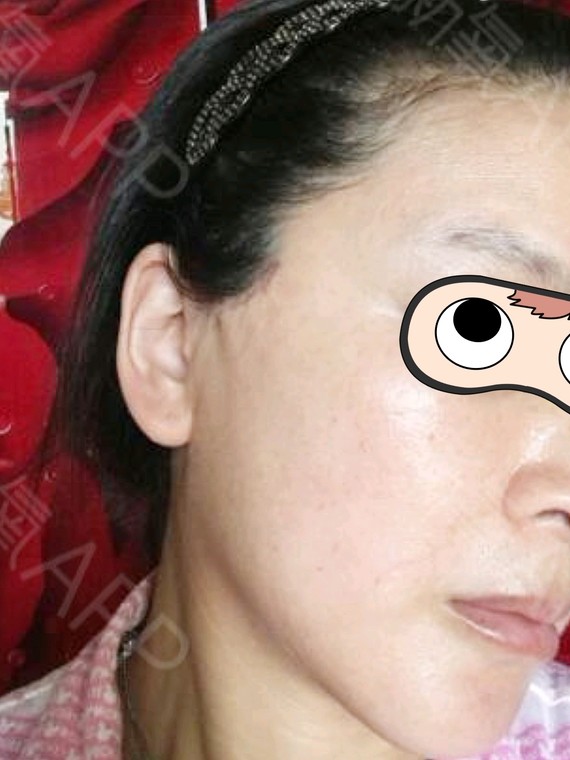 做完下面部拉皮手术差不多20天了,还是有点肿胀,现_圈子-新氧美容整形