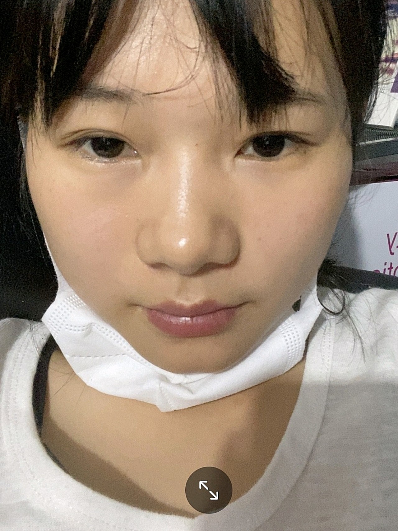 至今为止我都觉得当初选择鼻翼内切是一件很明智的选择_圈子-新氧美容