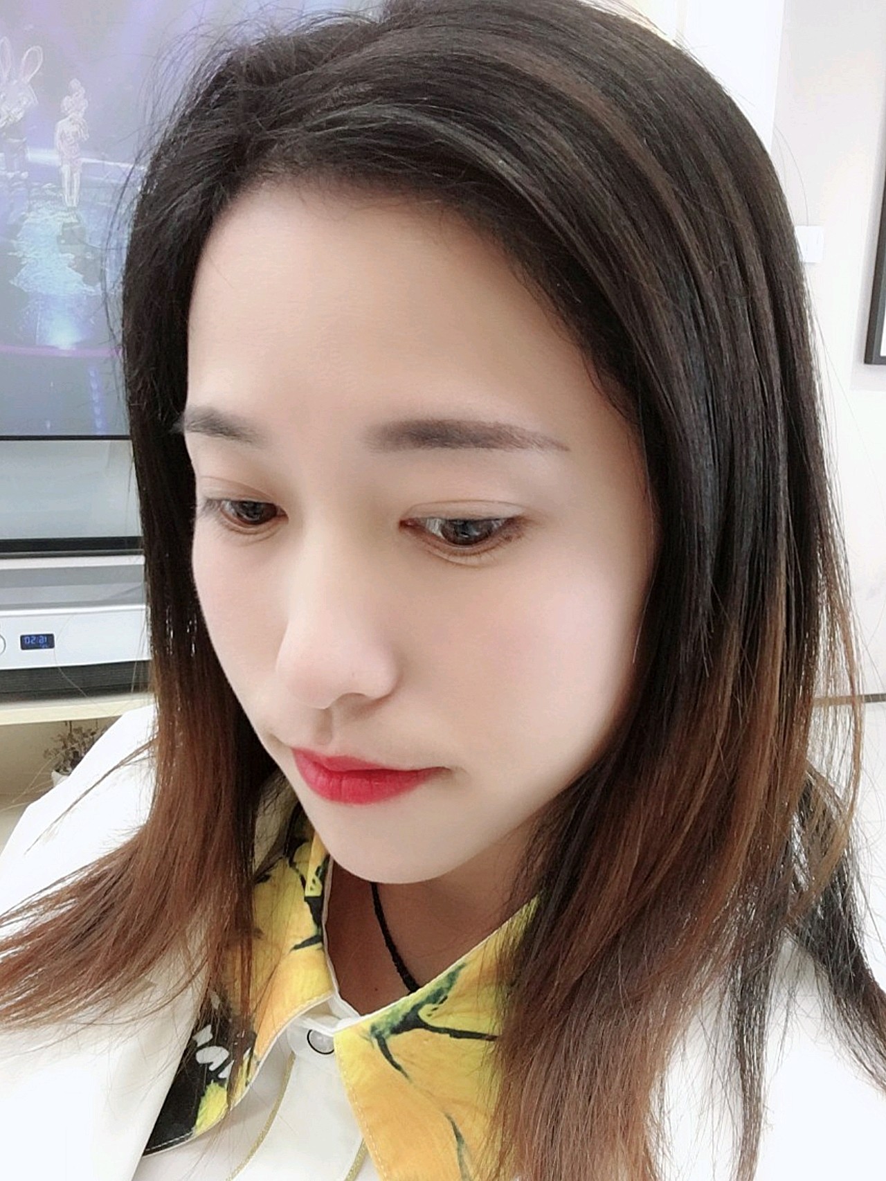 植发后142天(植发后130天效果)