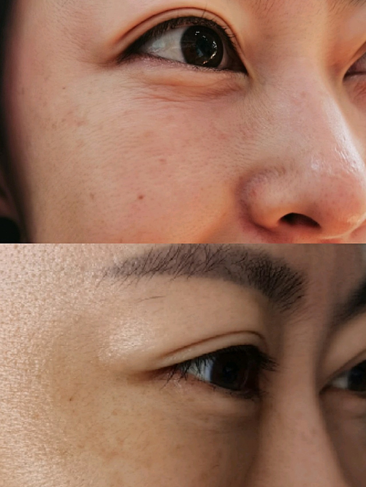 下眼睑皱纹怎么办