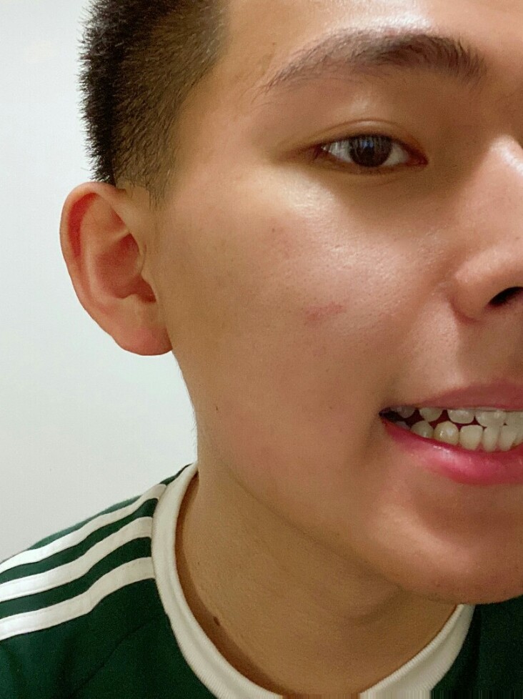 门牙矫正效果比较明显,以前有外翻的情况,现在基本都