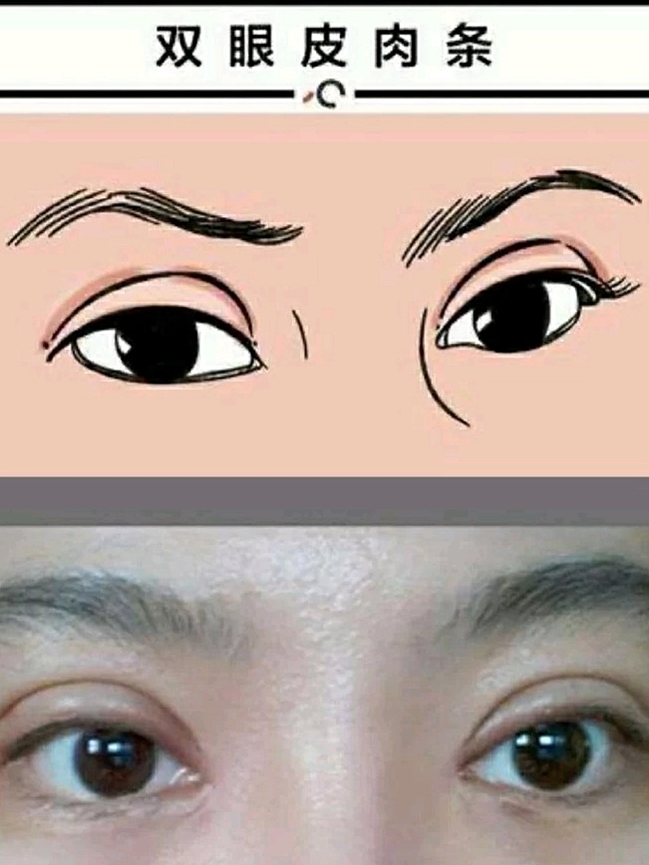 位置错误,固定在睑板组织上了 4:组织去除后,皮肤及其下疤痕的卷缩 5