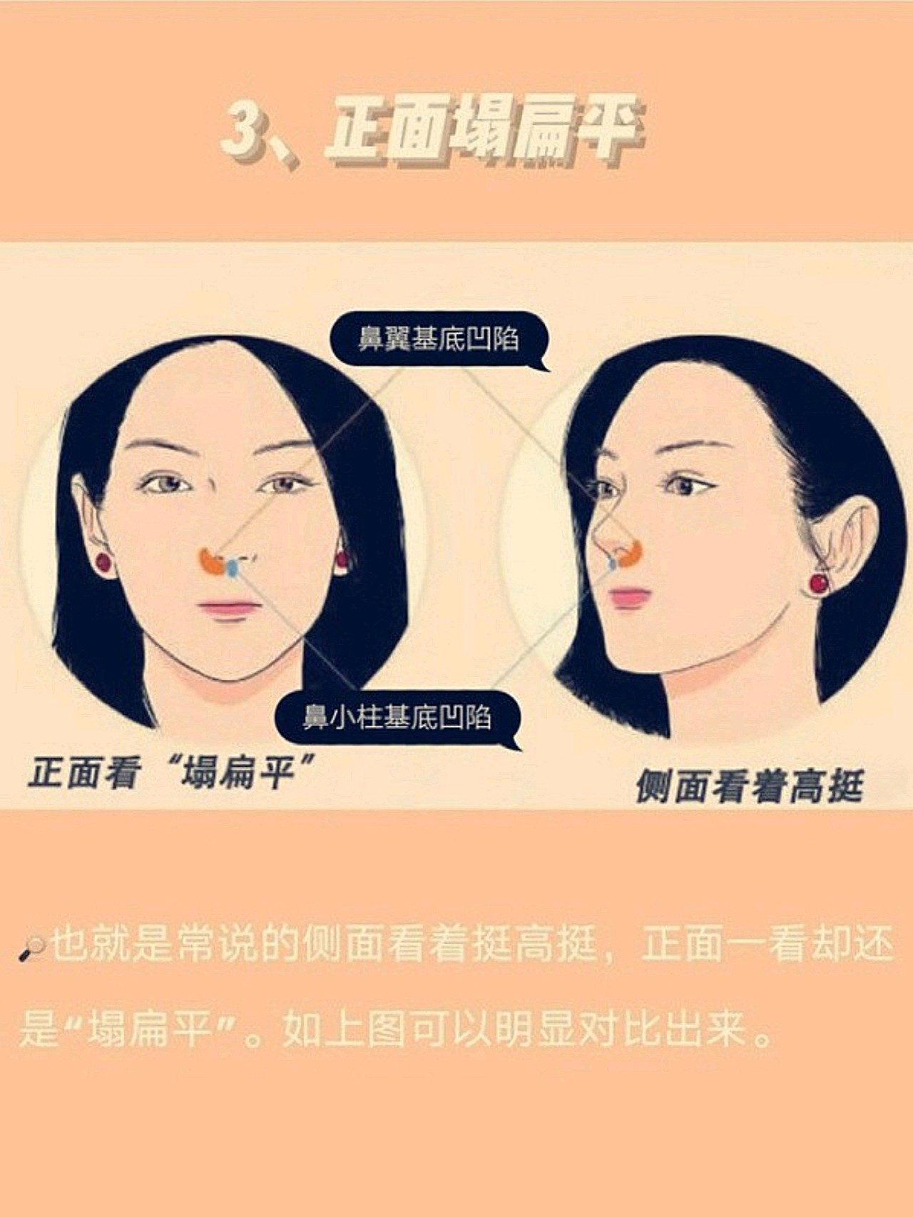 该怎么拯救你,凹陷的鼻基底?