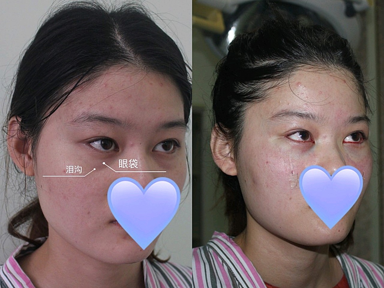 眶隔释放日记(张兵)