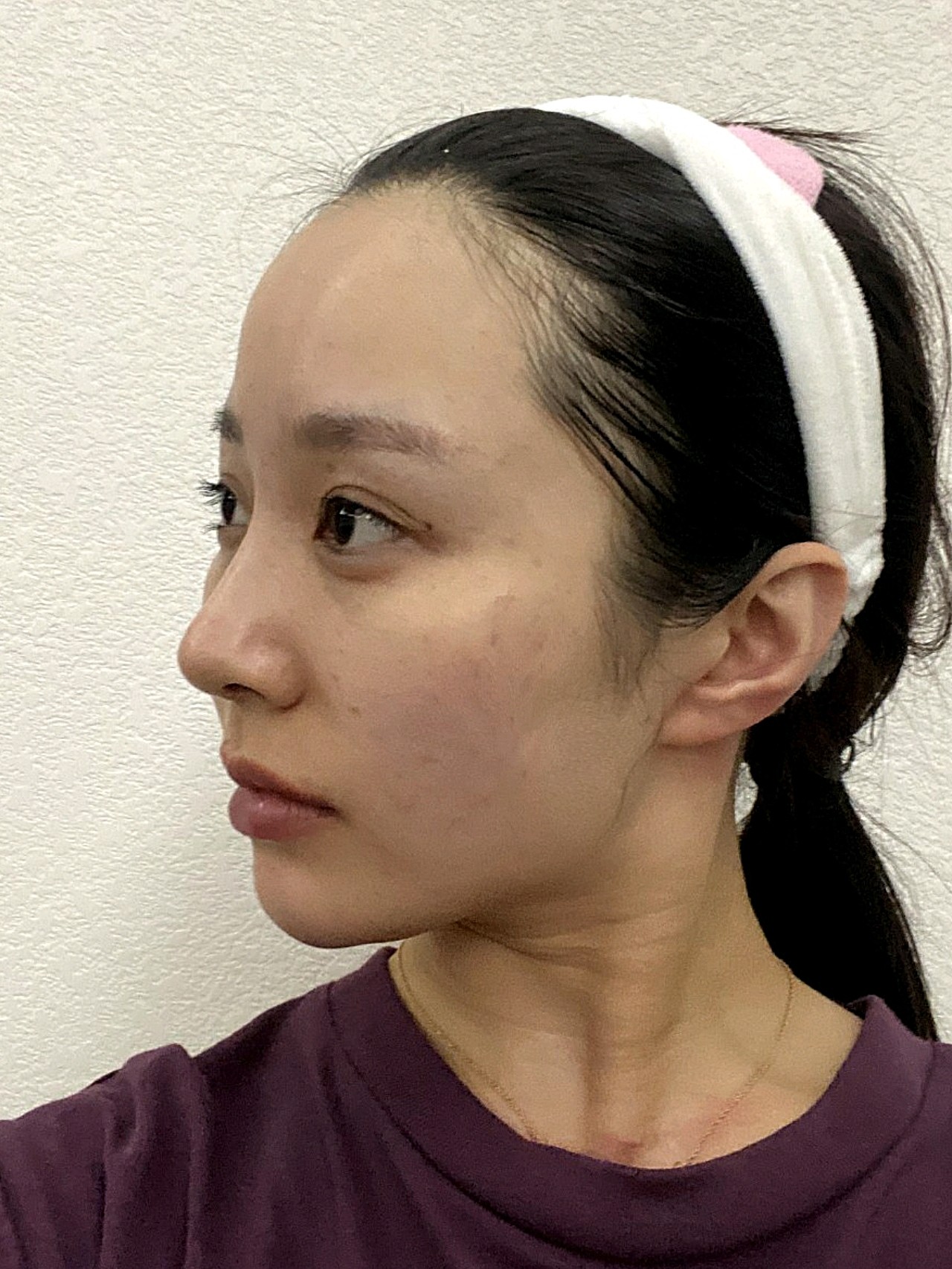 女生u型脸真的很丑,而我以前就是那个u型脸的女生,_圈子-新氧美容整形