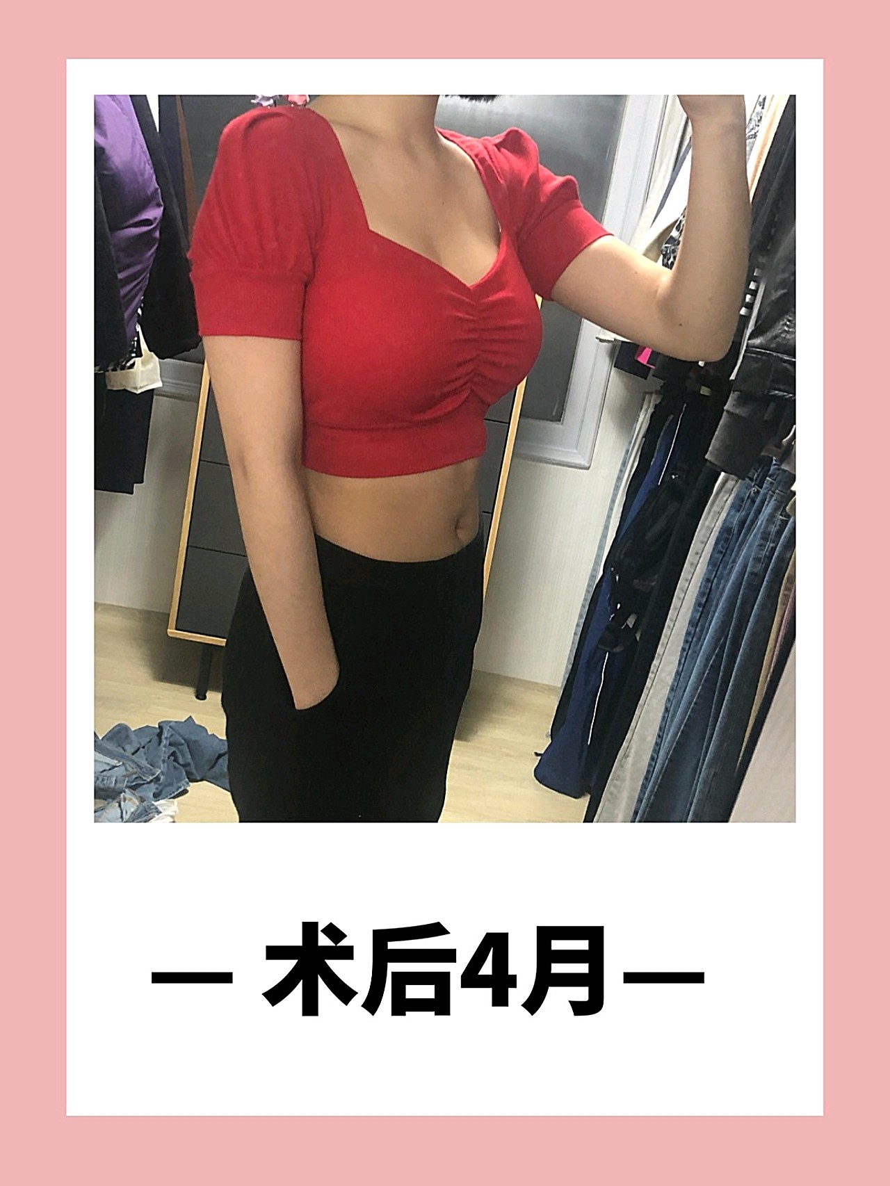 沈阳美莱医疗美容医院假体隆胸怎么样_恢复过程_效果如何_关上左耳整形日记6.25_新氧美容整形