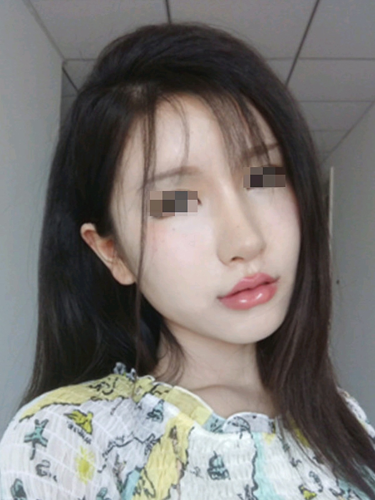 一直都觉得我的嘴巴不好看,听说可以注射玻尿酸丰唇后_圈子-新氧美容