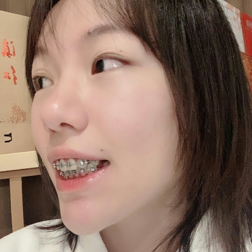 进口金属自锁矫正术后237天这个月戴了下牙的牙套,_圈子-新氧美容整形