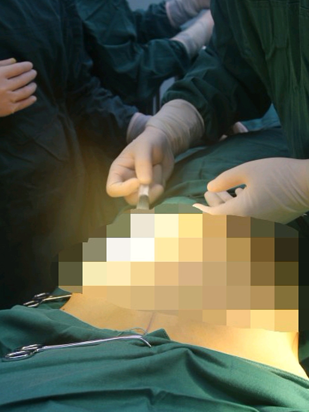 【星妍医美 自体脂肪丰胸】没有很瘦却没有胸是什么样_圈子-新氧美容