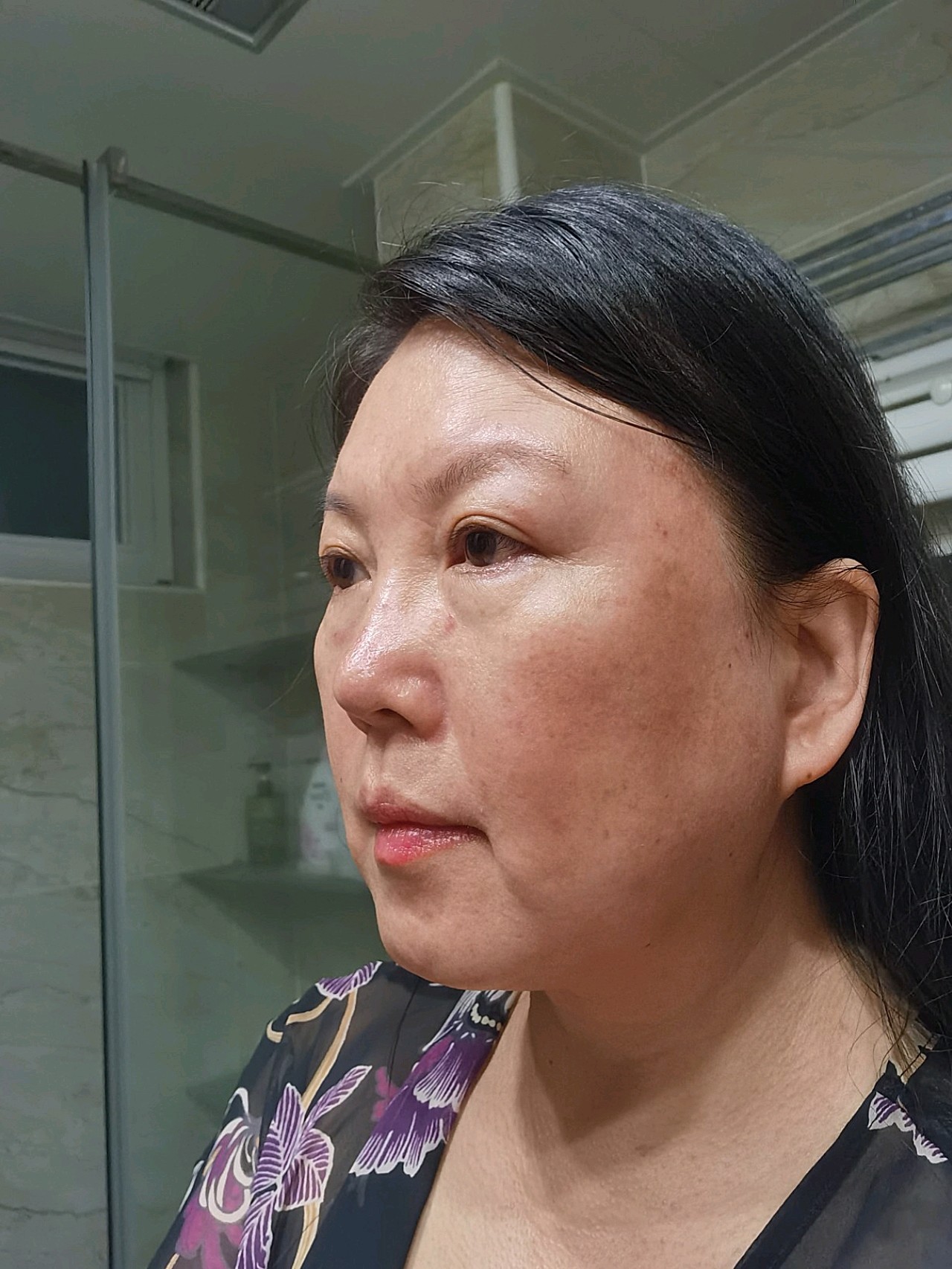 本人50岁,面部下垂比较厉害,下颌缘不清晰,有些双下巴.