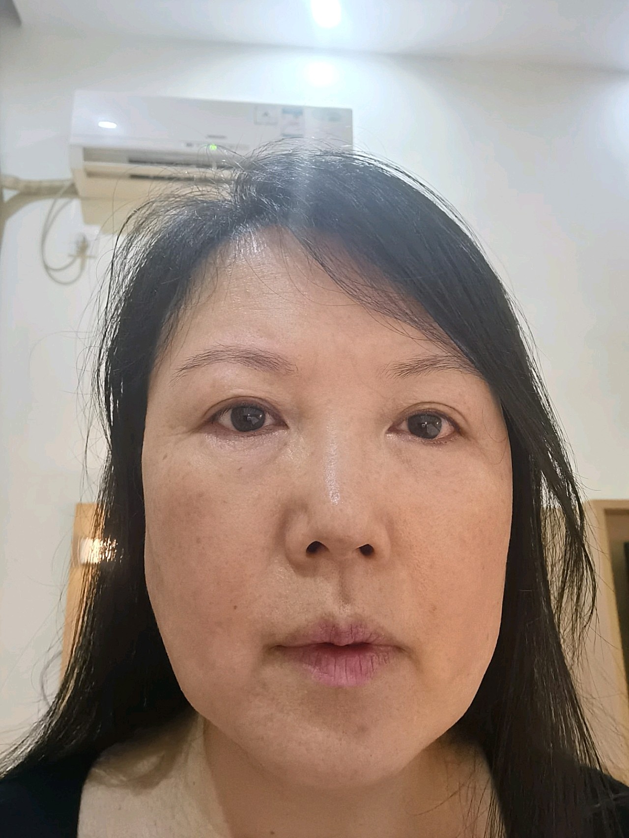 本人50岁,面部下垂比较厉害,下颌缘不清晰,有些双下巴.