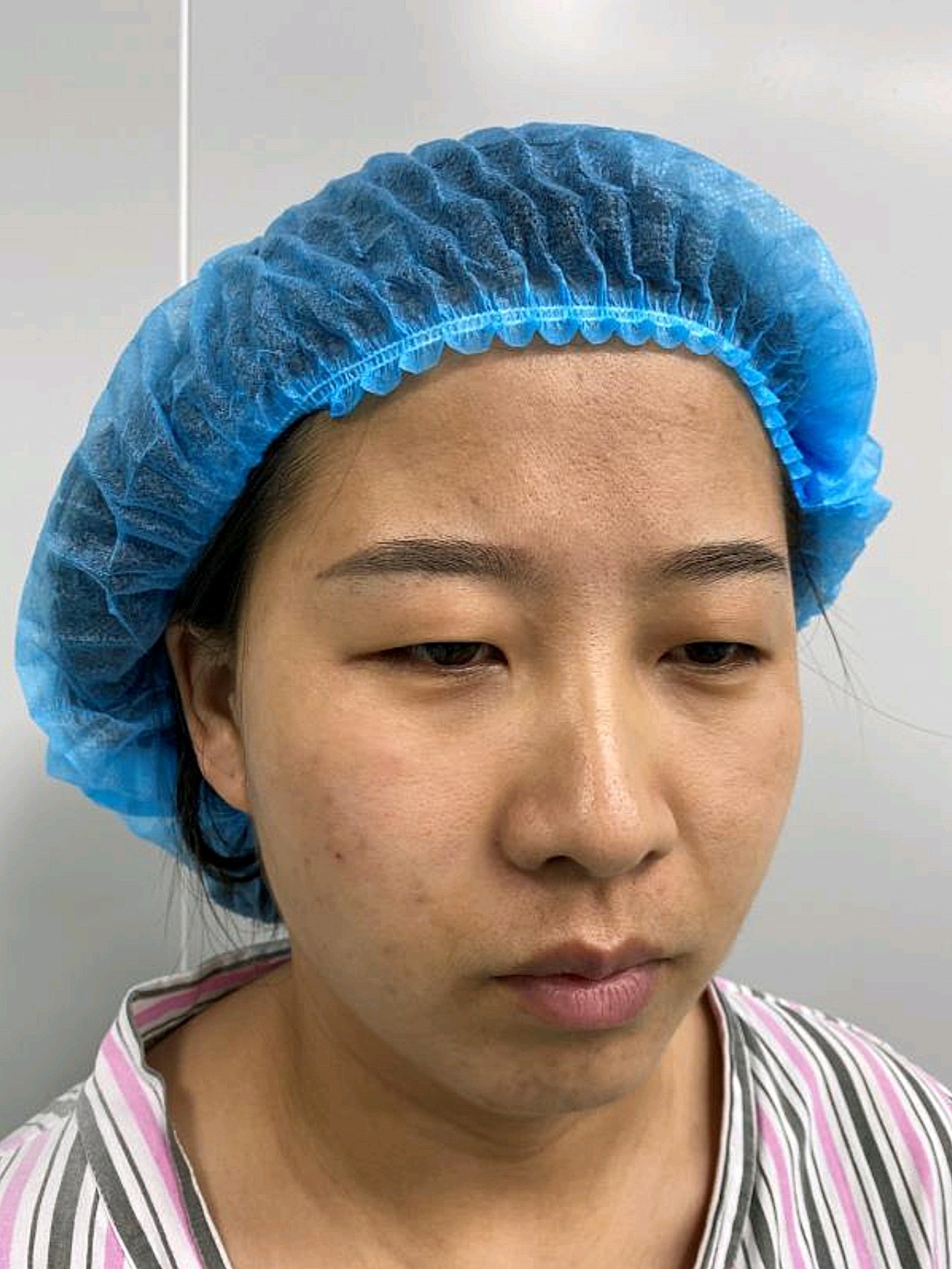 术前:一直觉得小眼睛不好看,看起来无神,其实我一开_圈子-新氧美容