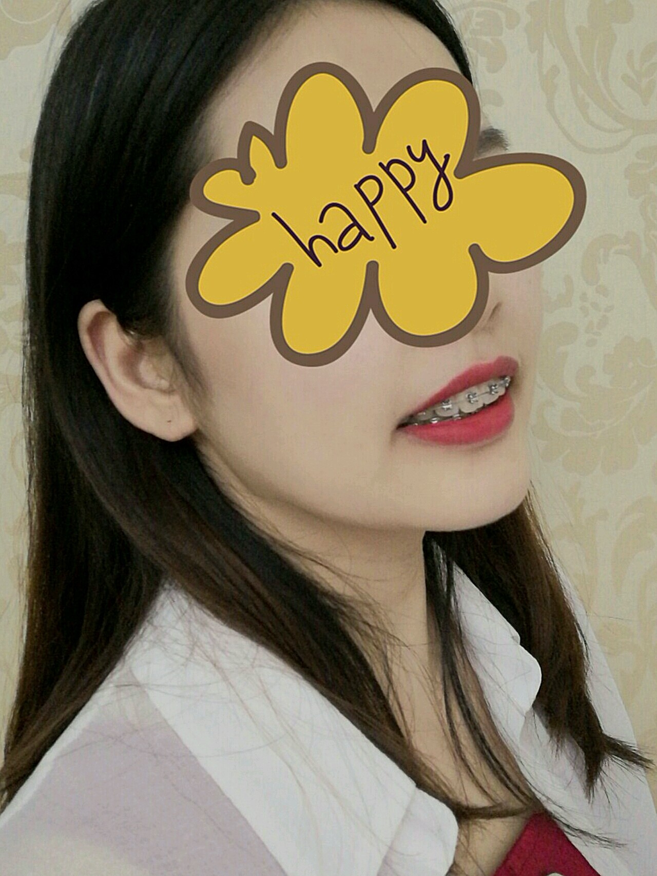 进口金属自锁矫正术后第238天##牙齿矫正