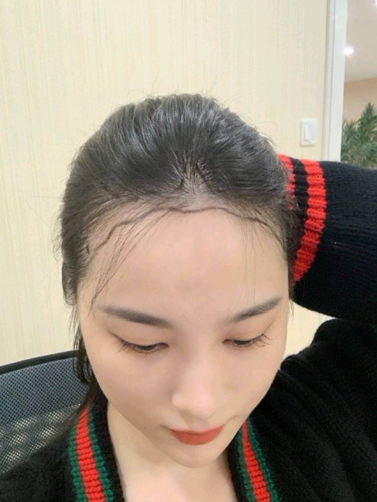 植发打卡非常奈斯,花瓣形状的发际线非常适合我的脸型_圈子-新氧美容