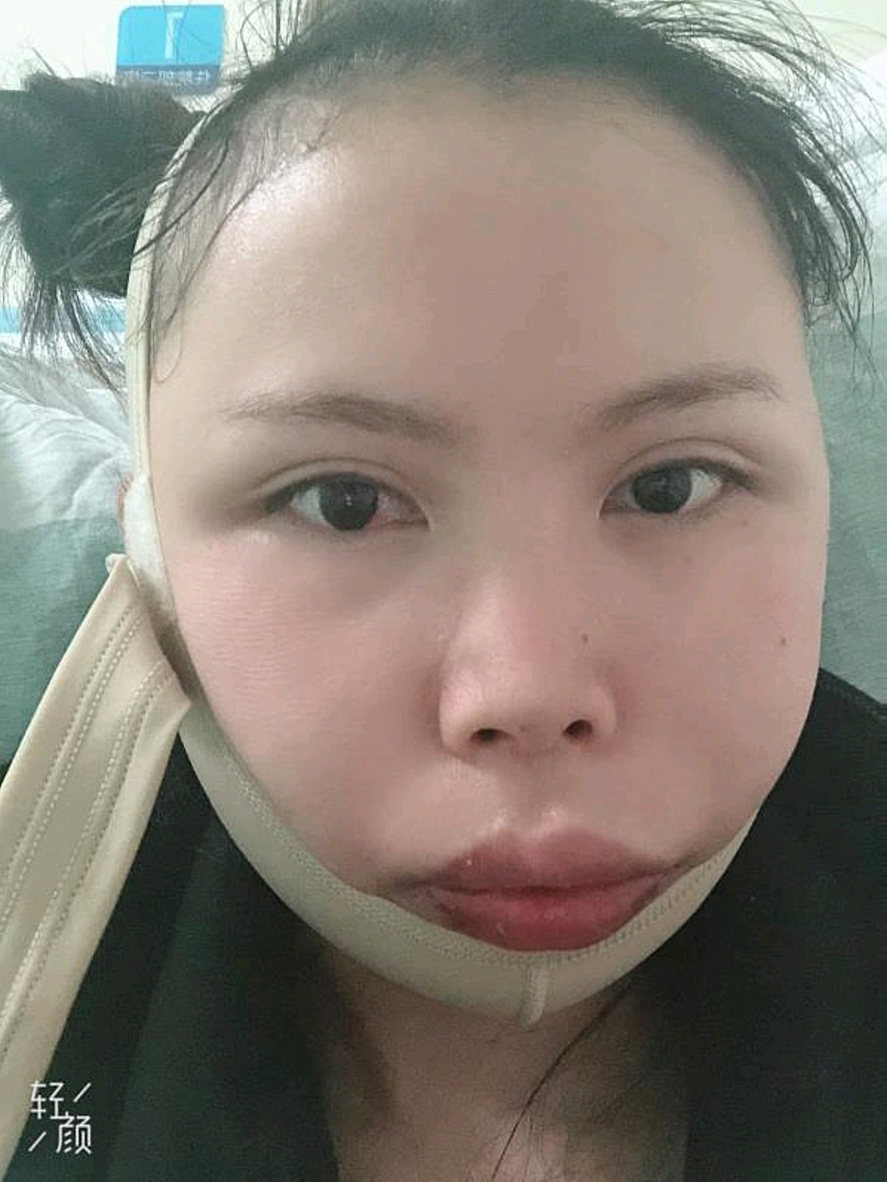 因为我的脸型,也不是大饼脸,但是就是骨头很凸出的