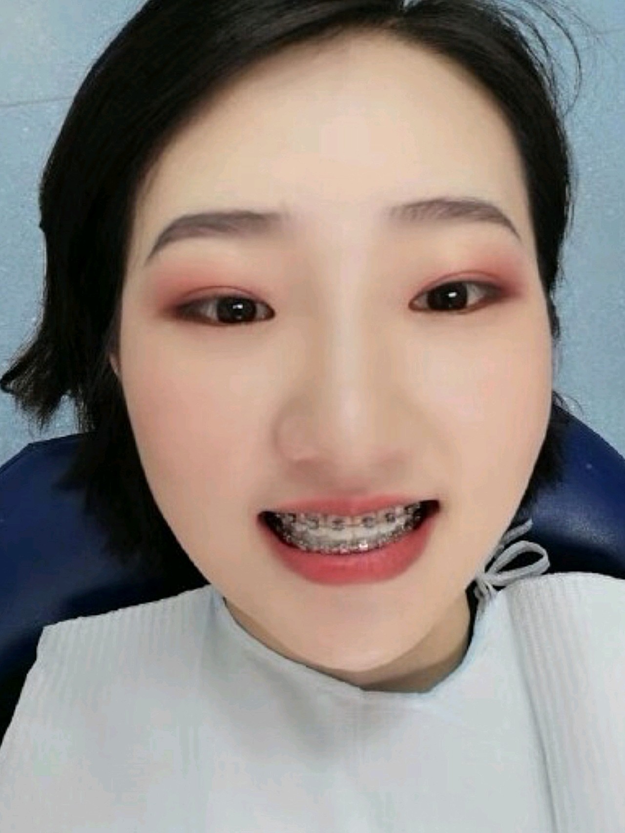 牙齿比较整齐,但每次聚会一起拍照,总会有些不尽人意.