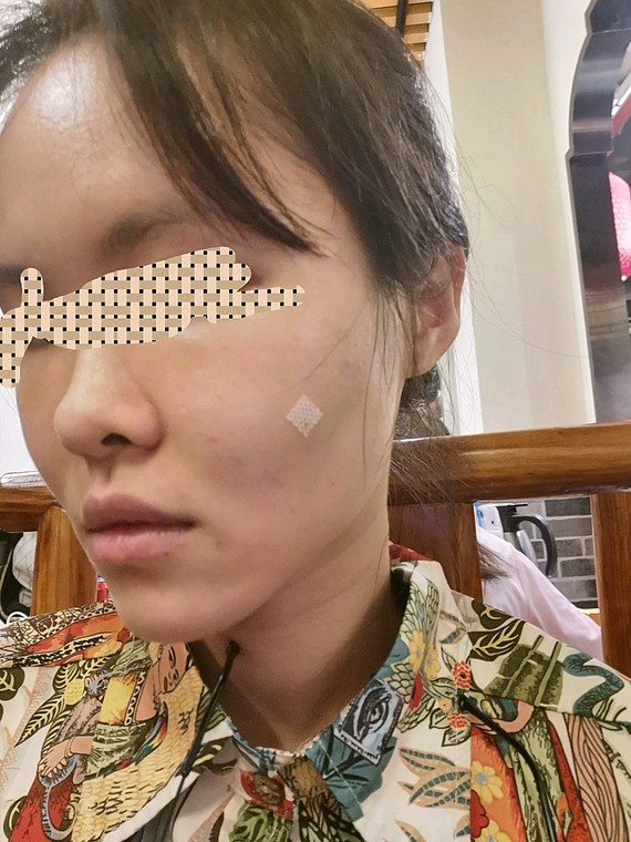 我额头天生就凸,就是脸颊凹陷,然后有泪沟,苹果肌不_圈子-新氧美容