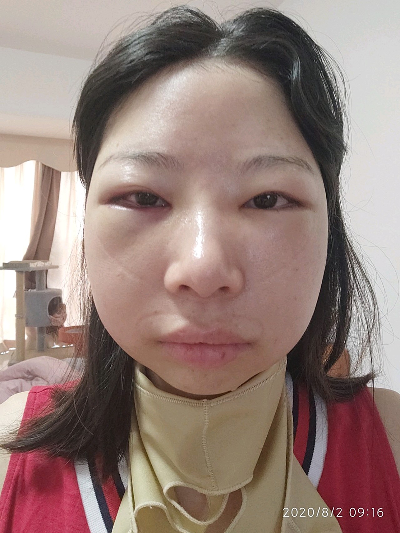 第二天出院了,感觉眼睛格外肿,脸部还能接受