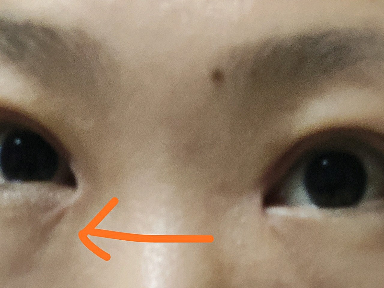 开眼角那里有个褶皱,一个半月了,应该是消不了了.