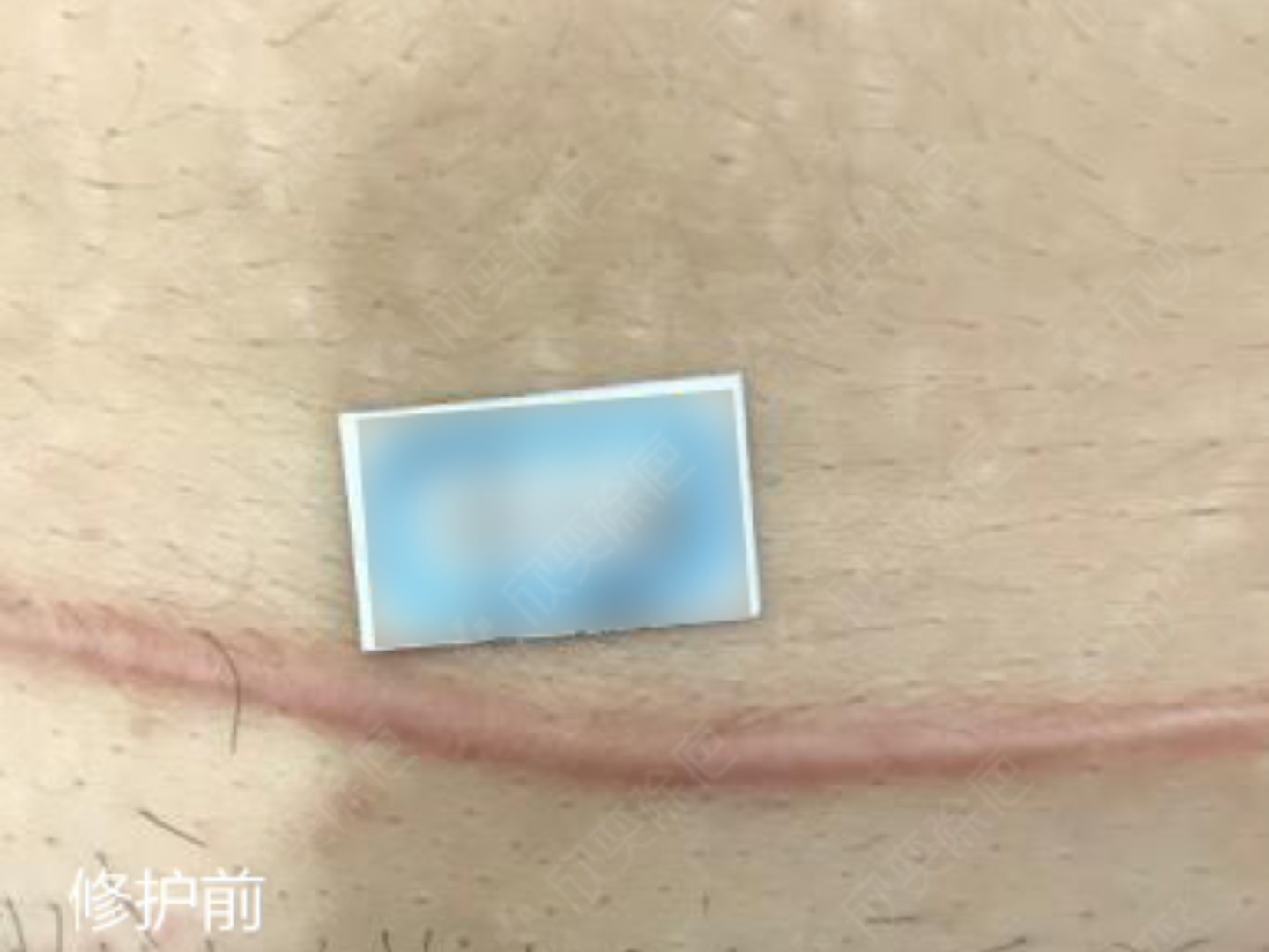 剖腹产疤痕,之前以为要打疤痕软化针,但是疤痕镇不敢打,毕竟是哺乳期.