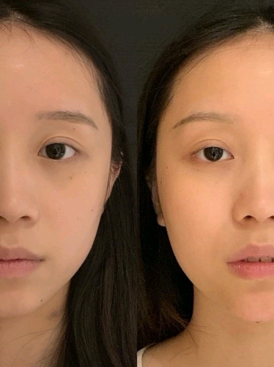 玻尿酸注射丰下巴,我也get了侧颜杀,后悔没有早点去!