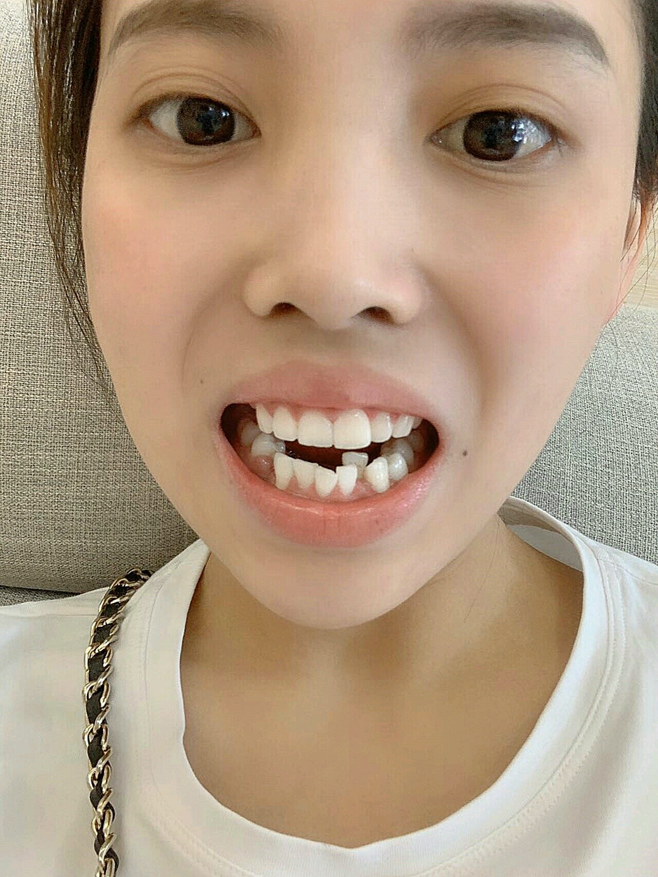 原先我的牙都是歪歪扭扭的,真的有时候都不太想开