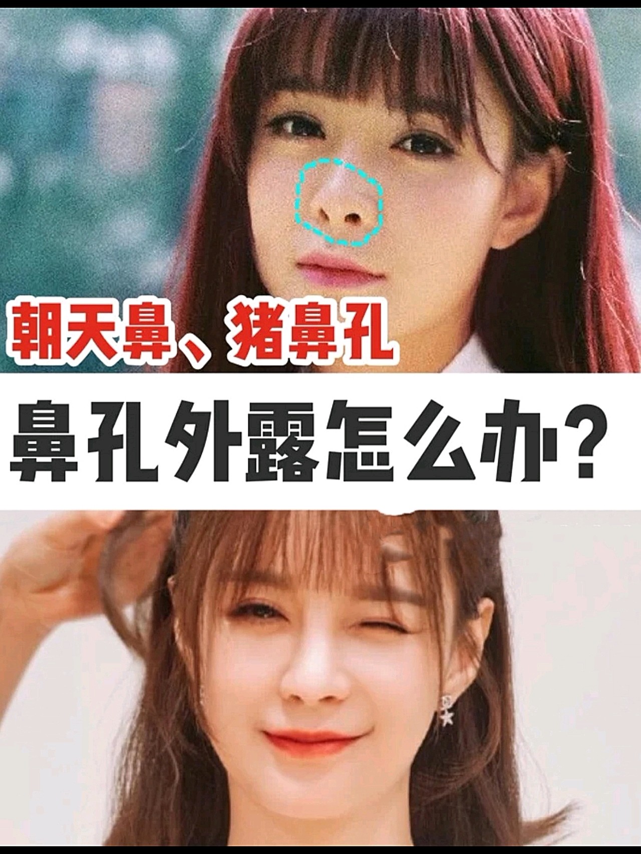 猪鼻孔95鼻孔外露该怎么办719199猪鼻子or朝_圈子-新氧美容