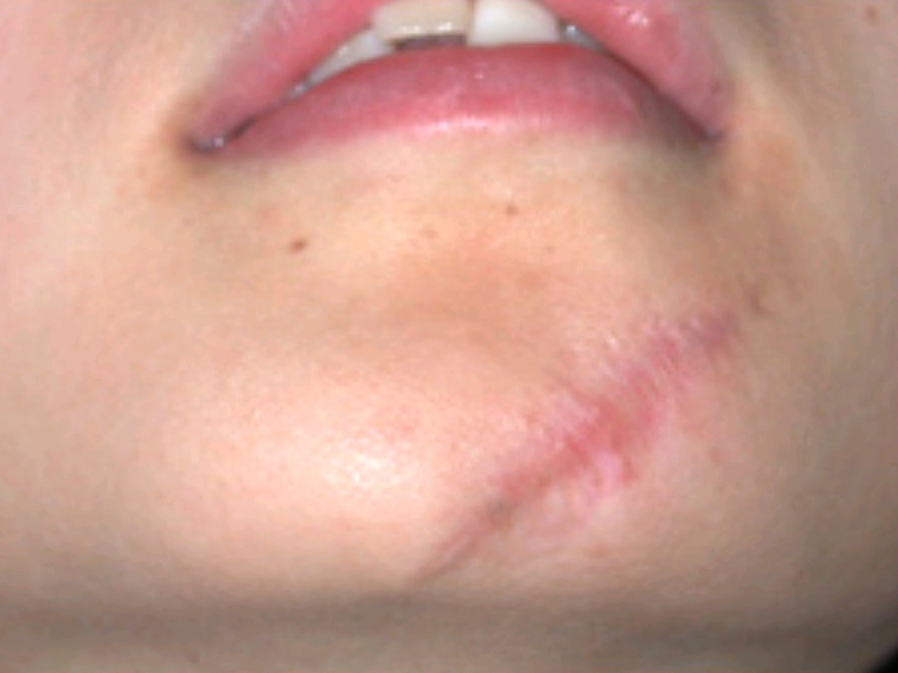 本身我就有点类似疤痕体质,之前下巴上磕伤留下很大的_圈子-新氧美容