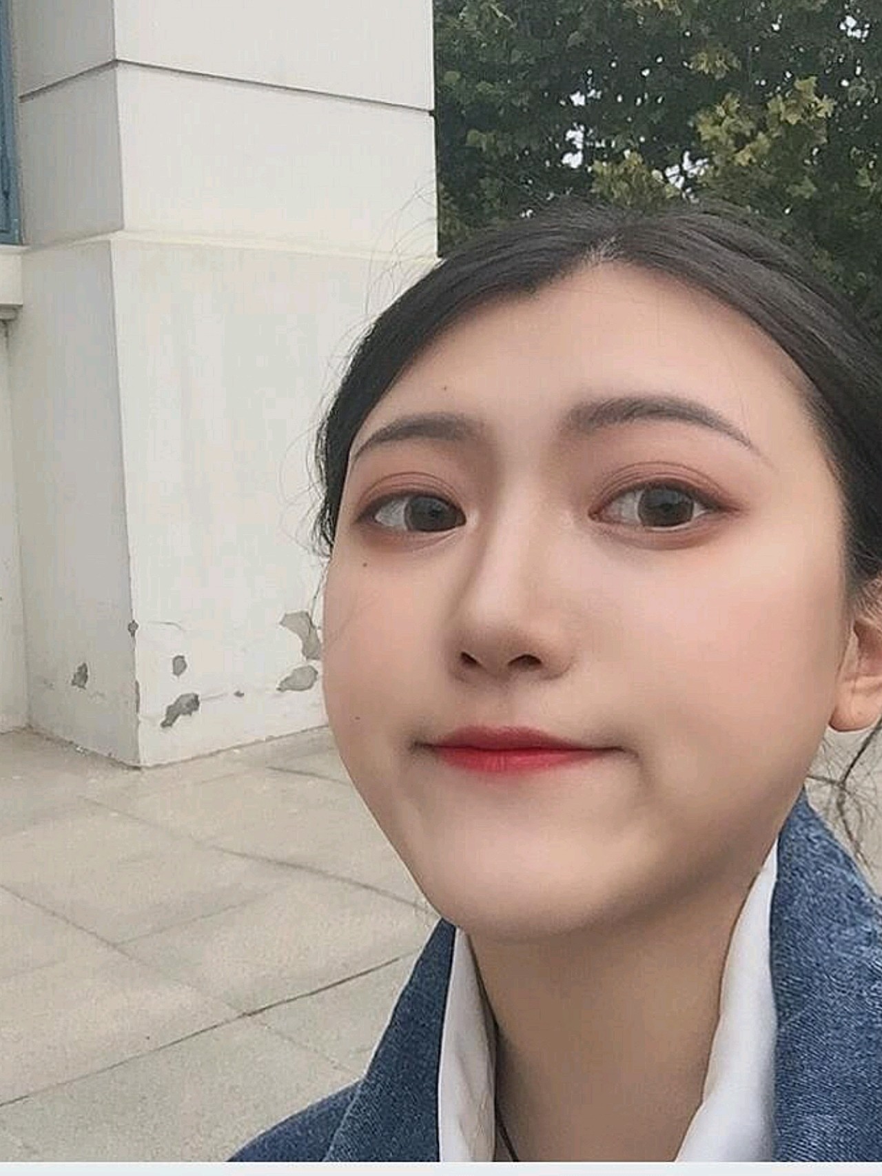 医生说后期恢复好了就会变软一些山根的地方恢复的非 圈子 新氧美容整形