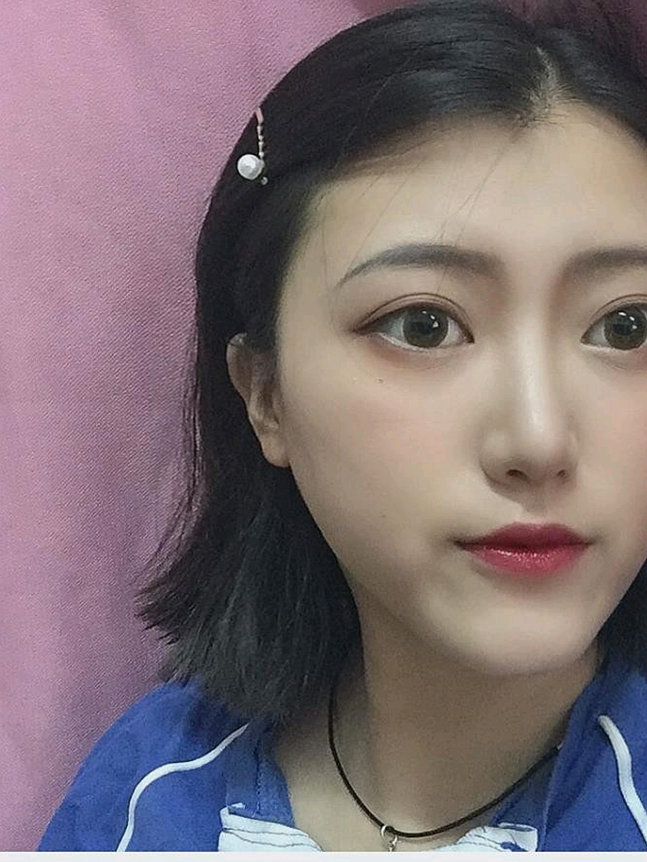 医生说后期恢复好了就会变软一些山根的地方恢复的非 圈子 新氧美容整形