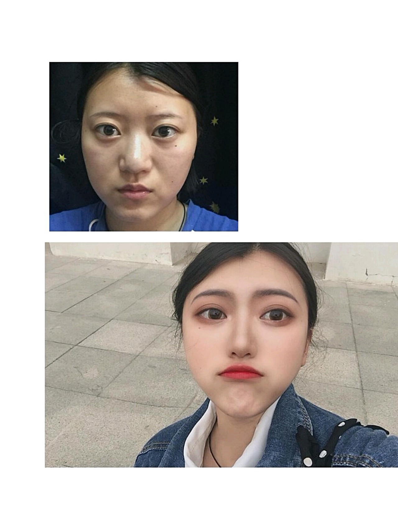 医生说后期恢复好了就会变软一些山根的地方恢复的非 圈子 新氧美容整形