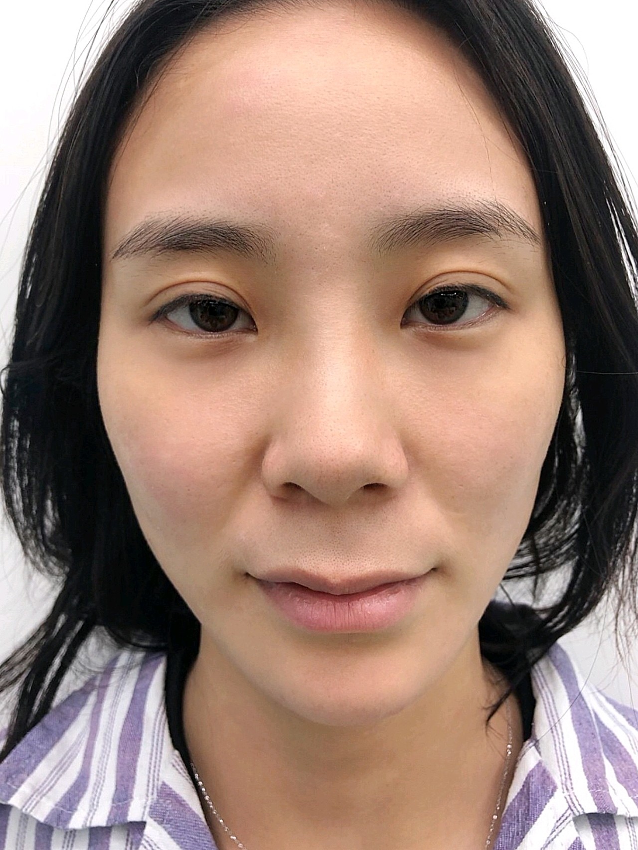 人中过长显老真的很令人秃头,本来没想分享,但是术后_圈子-新氧美容