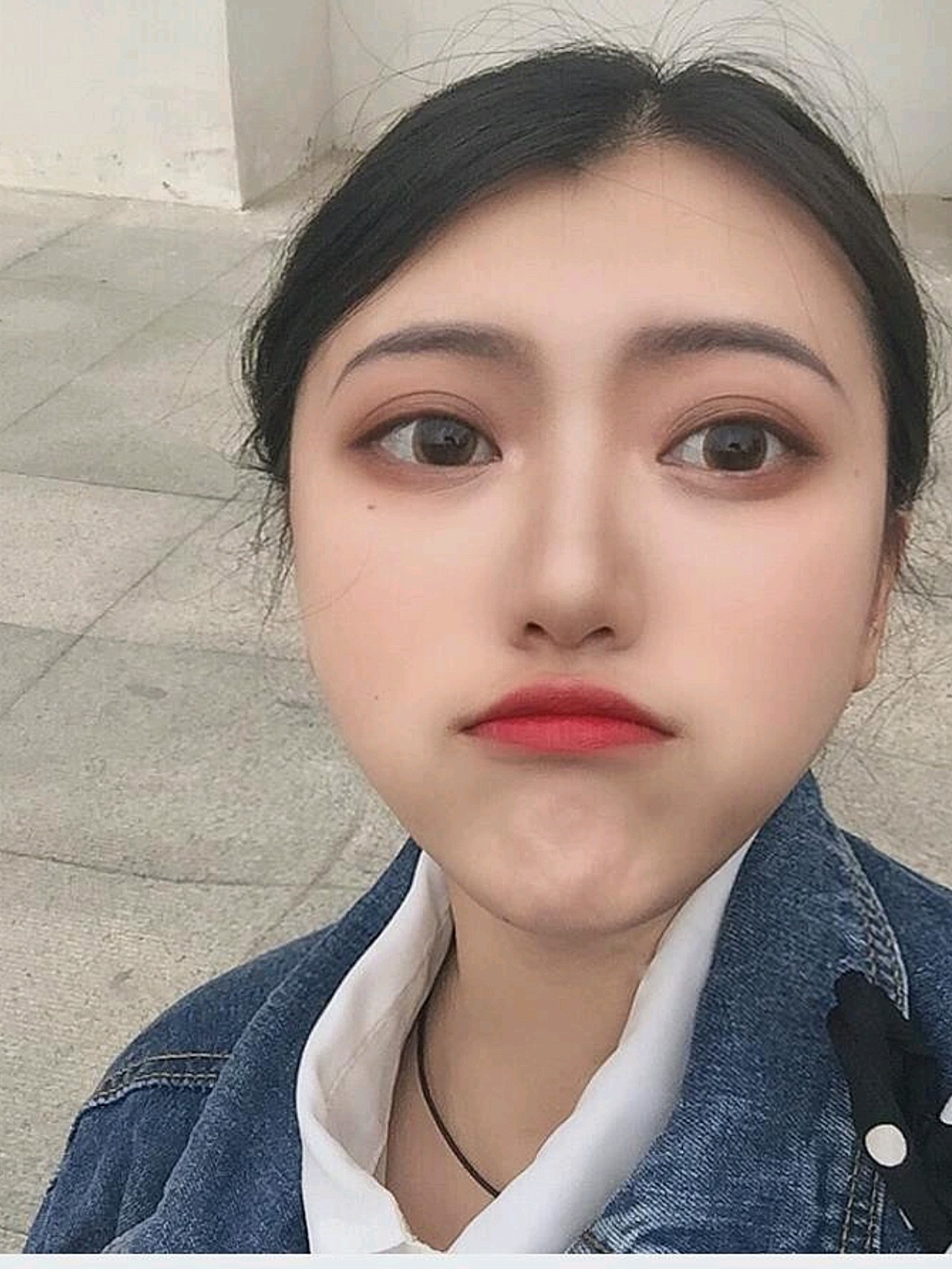 医生说后期恢复好了就会变软一些山根的地方恢复的非 圈子 新氧美容整形