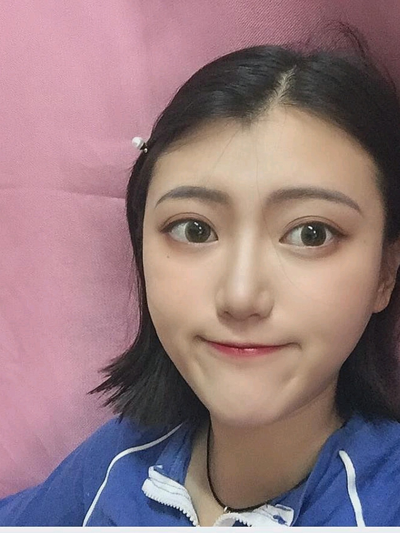 医生说后期恢复好了就会变软一些山根的地方恢复的非 圈子 新氧美容整形