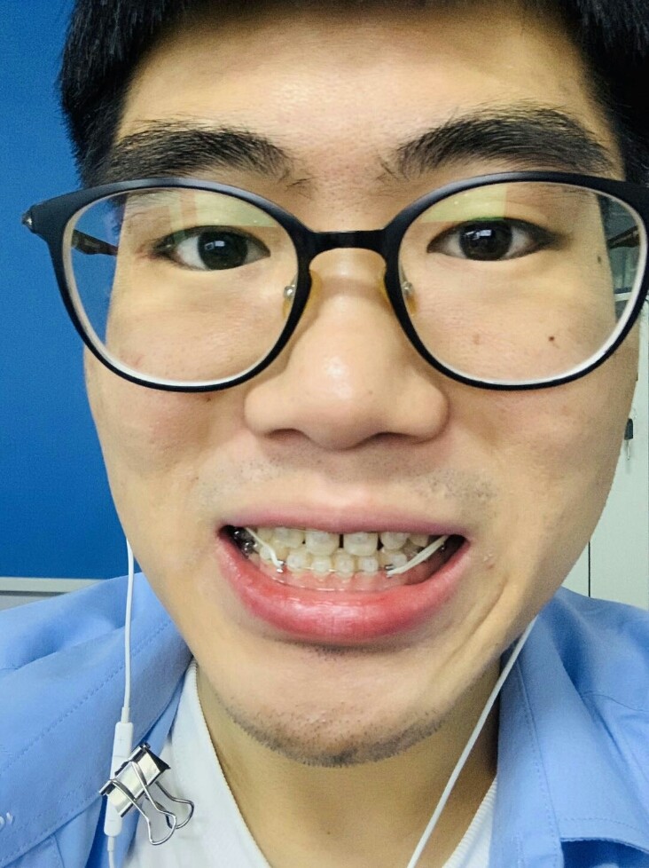 【陶瓷自锁牙套第三篇】