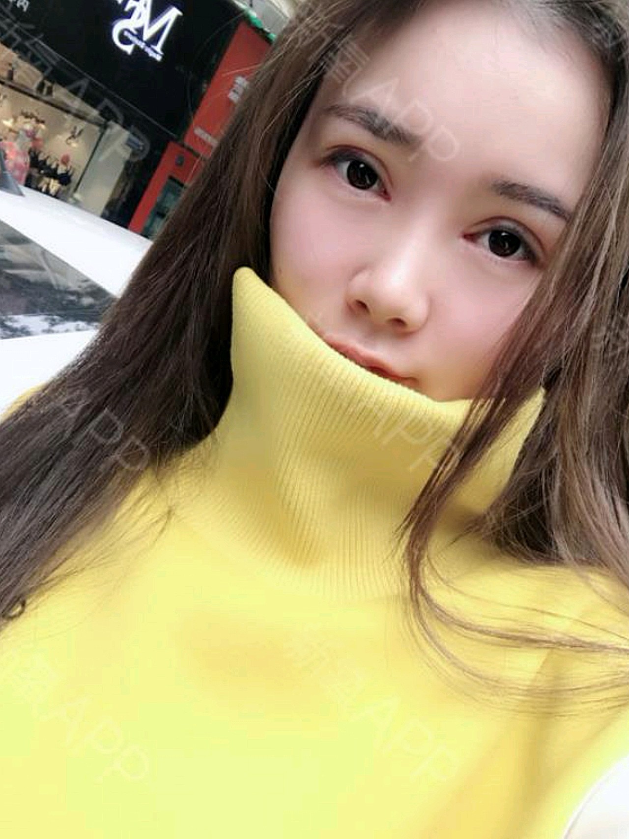 [双眼皮修复术后第15天]