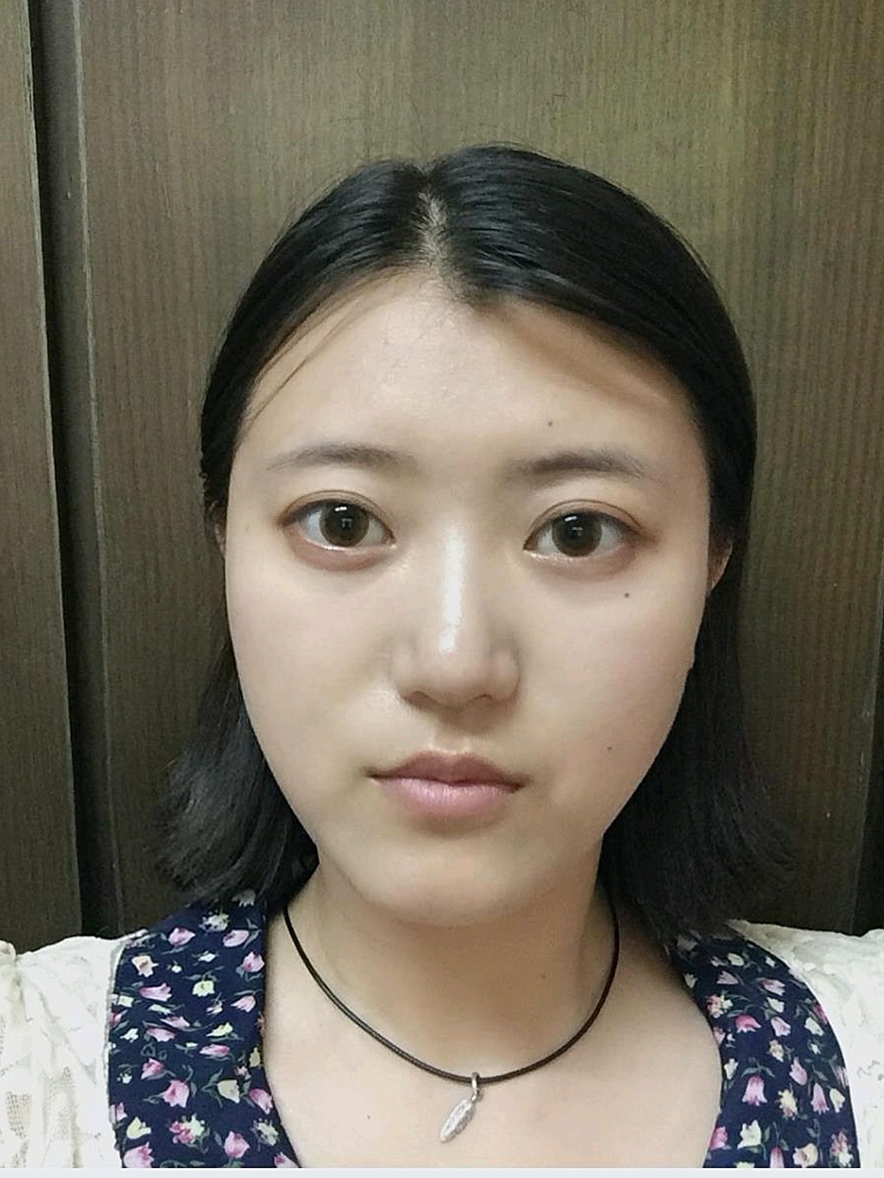 医生说后期恢复好了就会变软一些山根的地方恢复的非 圈子 新氧美容整形