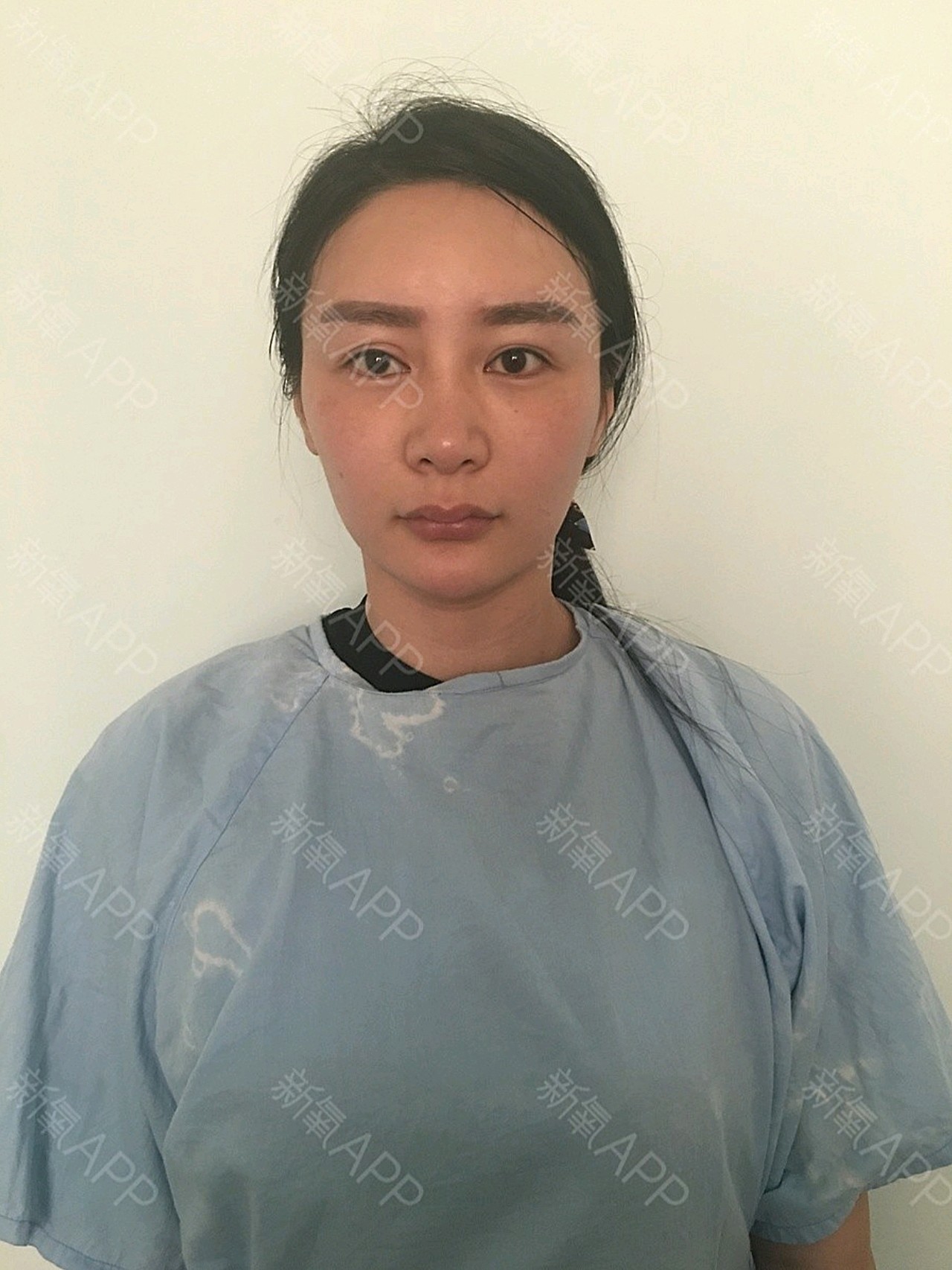 今天预约上午去青岛徐健整形医院做自体脂肪填充全面部_圈子-新氧美容