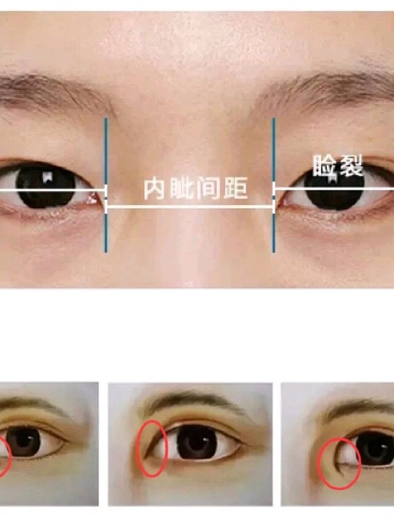 是不是都会被推荐开眼角这个手术开内眼角的确可以改善睑裂的大小,让