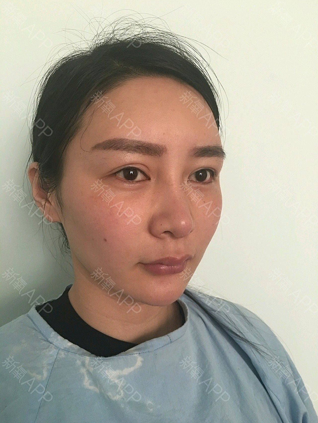 今天预约上午去青岛徐健整形医院做自体脂肪填充全面部_圈子-新氧美容