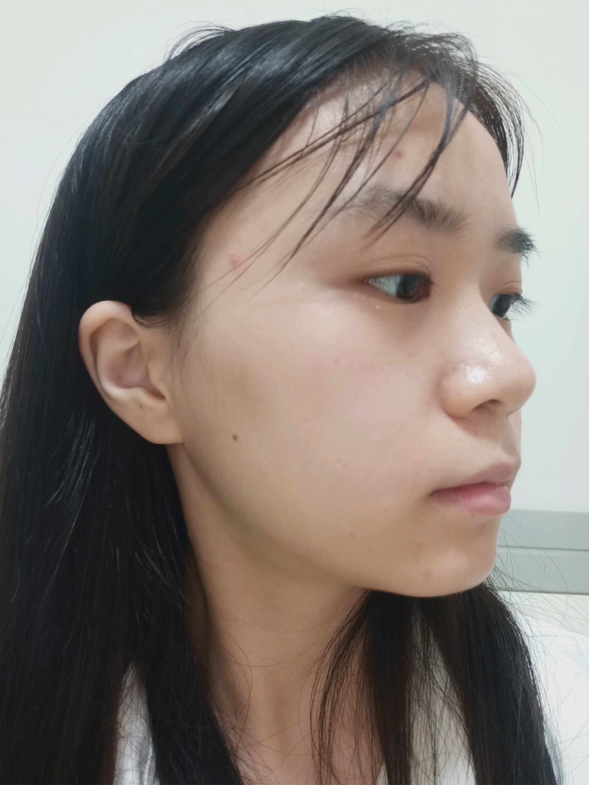 因为长期戴眼镜导致面部发育的越来越丑麻烦医生帮我看看我是什么脸型