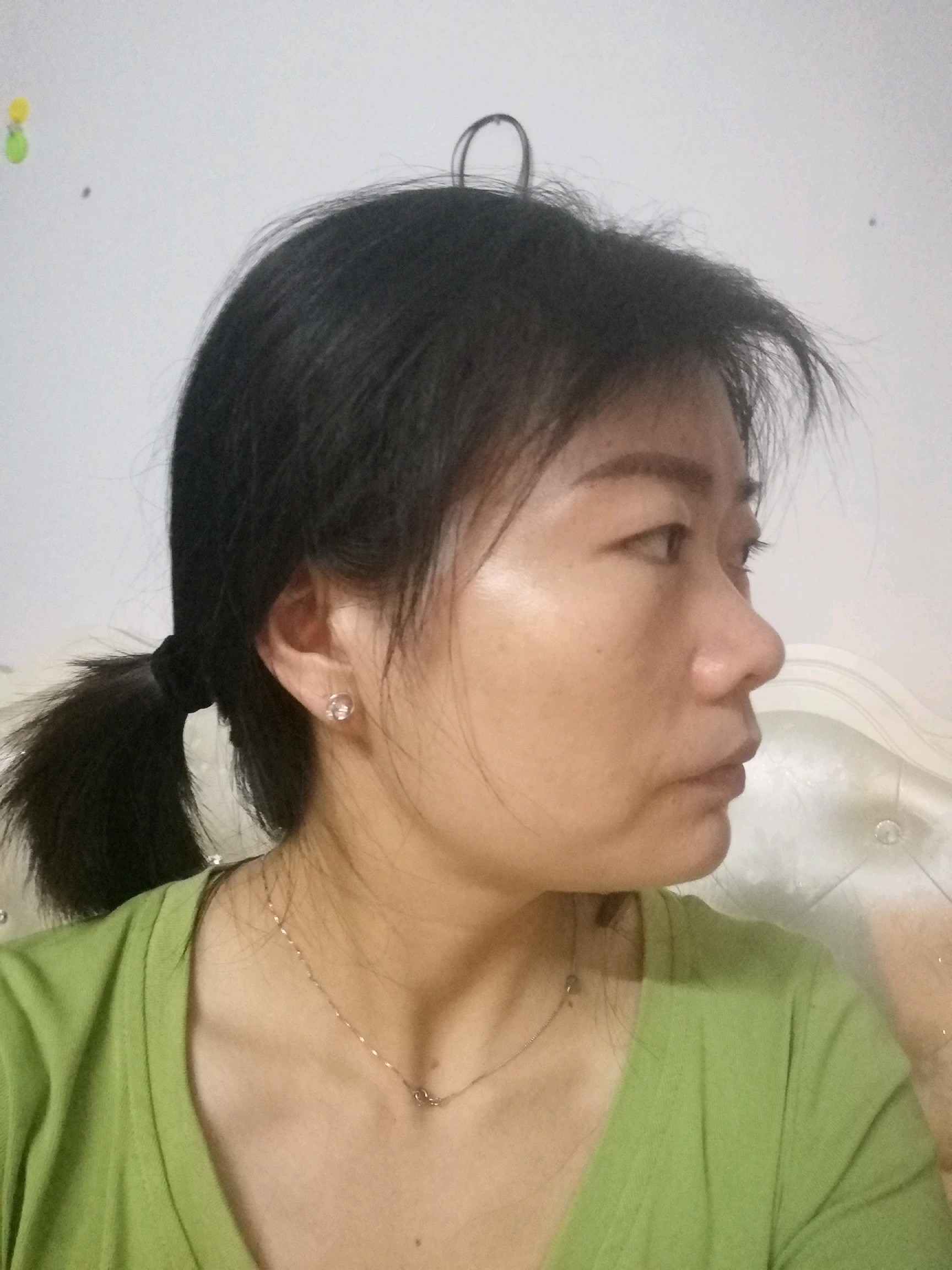 颧骨突出太阳穴凹陷的厉害大小眼脸部塌陷侧面也塌陷请问有救吗我估计