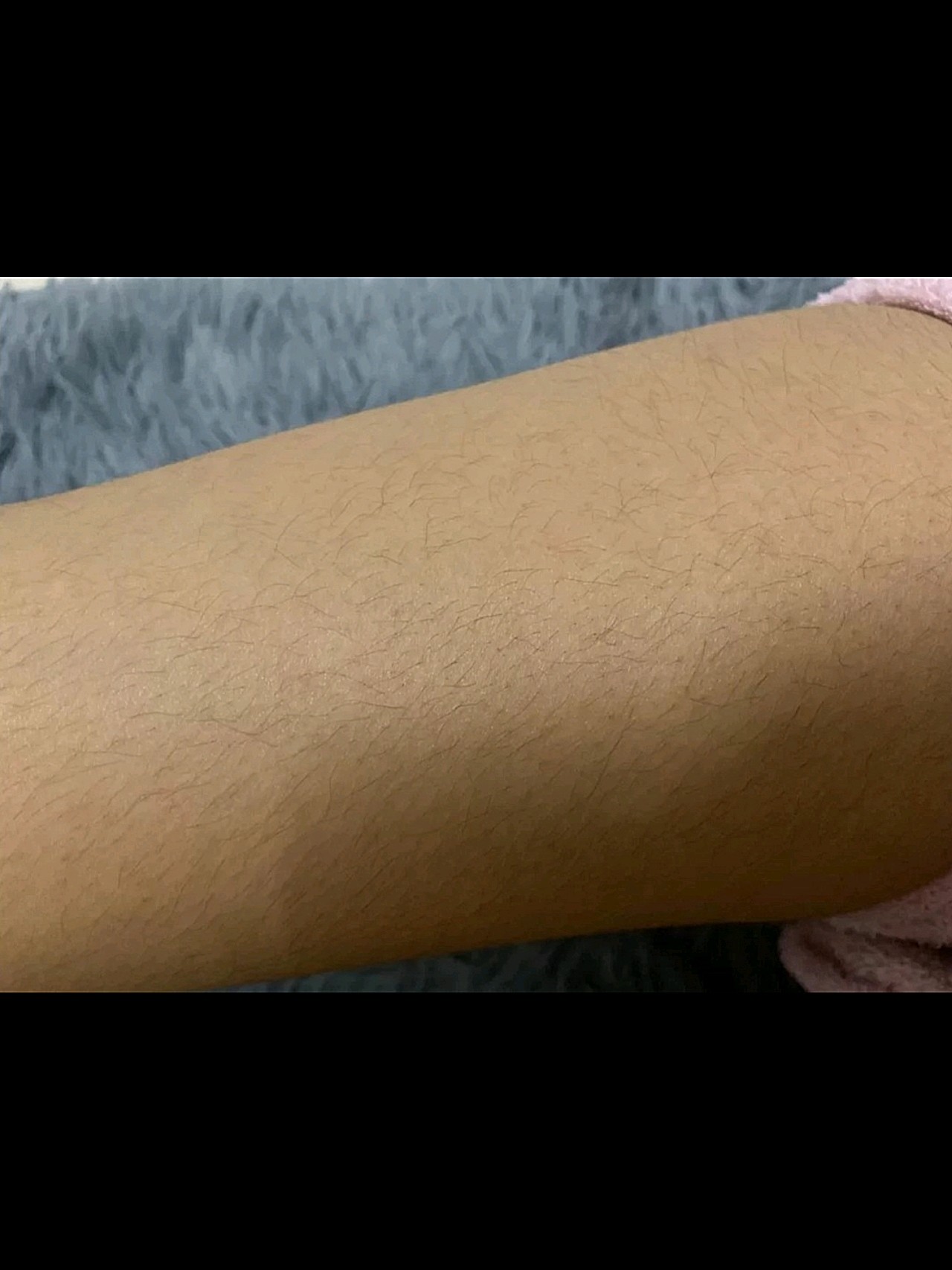 进口仪器脱毛之前没有脱过毛,我腿毛,手臂毛,特别重_圈子-新氧美容