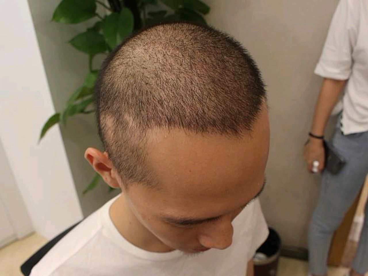 大麦微针植发术后15天,植发半个月了,去医院复查了_圈子-新氧美容整形