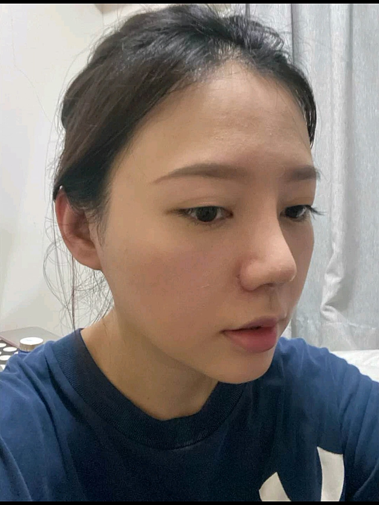 一开始感觉怪怪的,山根这块突然高了很_圈子-新氧美容整形