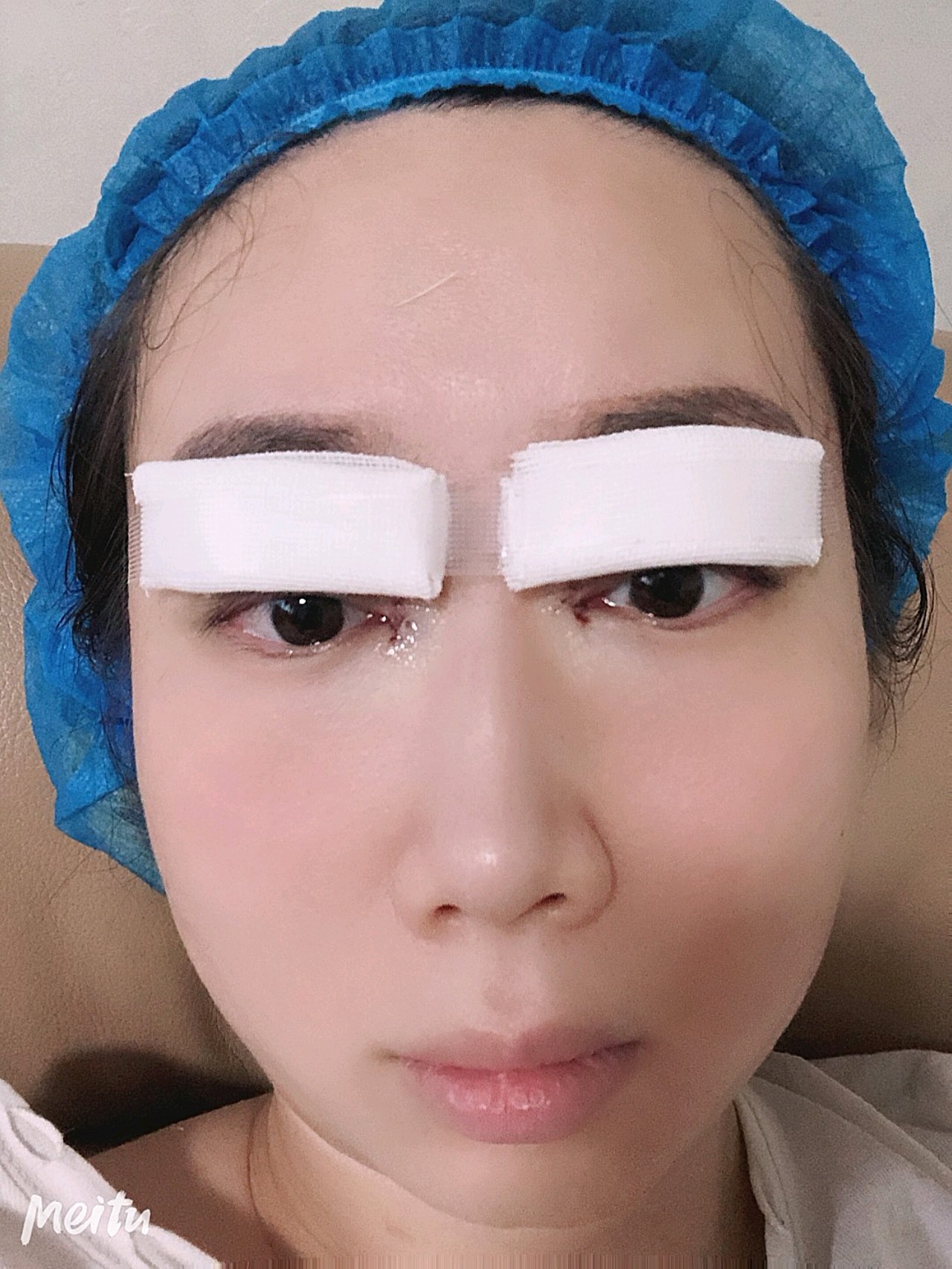 今天第二天了,眼睛还是用纱布包着呢,但是看上去还是_圈子-新氧美容